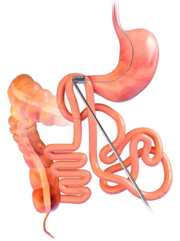 Illustration of the digestive system, with the two small magnets meeting between two sections of the gut